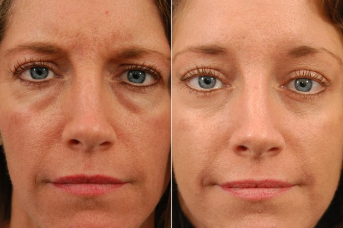 Images of Eyelid Surgery Covered by Insurance